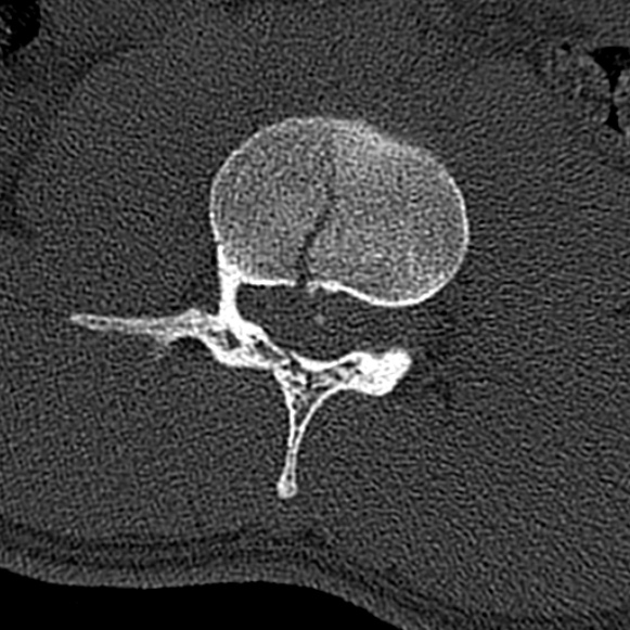 Burst fracture (Radiopaedia 53373-59357 Axial bone window 36).jpg