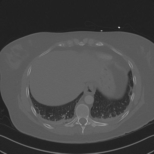 Burst fracture - thoracic spine (Radiopaedia 30238-30865 Axial bone window 71).jpg