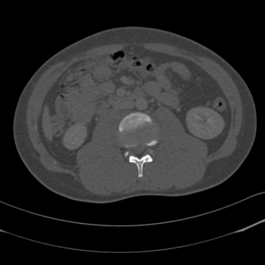 Burst fracture with cauda equina syndrome (Radiopaedia 25701-25867 Axial bone window 68).jpg