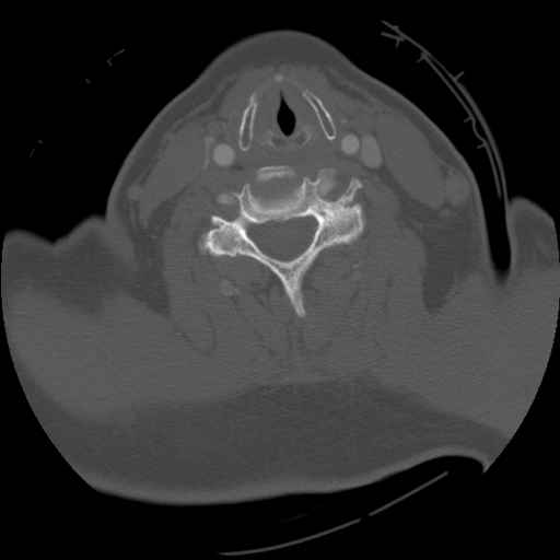 File:C1 anterior arch (plough) fracture - type 1 (Radiopaedia 76181-87720 Axial bone window 52).jpg