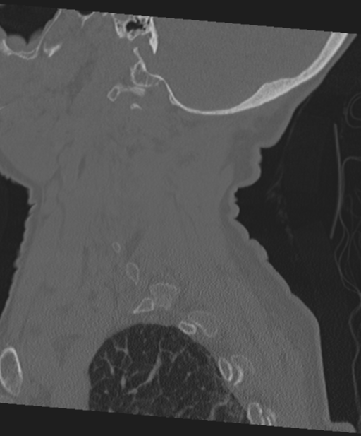 C2 fracture with vertebral artery dissection (Radiopaedia 37378-39199 Sagittal bone window 59).png