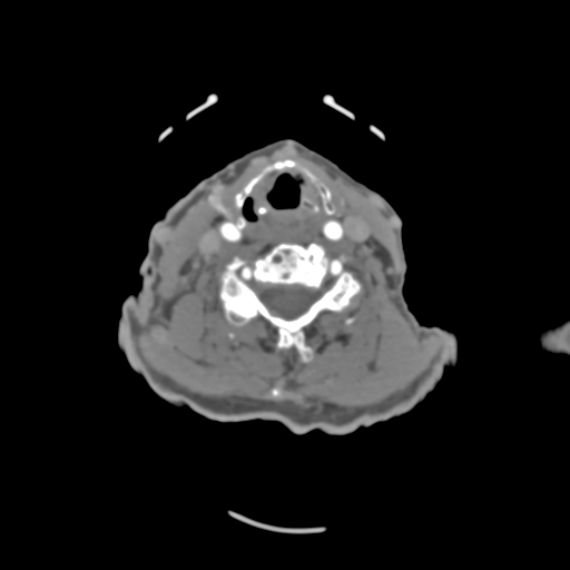C2 fracture with vertebral artery dissection (Radiopaedia 37378-39200 A 114).png
