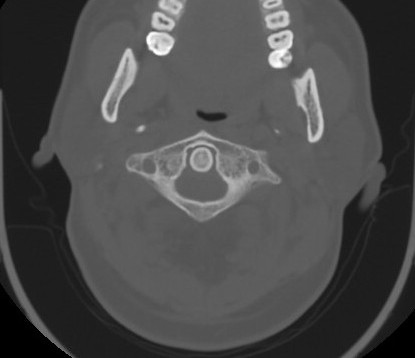 C7 laminar fracture and Klippel-Feil syndrome (Radiopaedia 86710-102850 Axial bone window 24).jpg