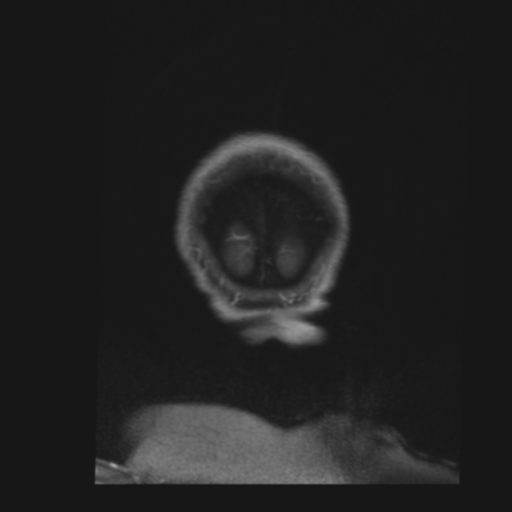 File:CNS lymphoma with steroid response (Radiopaedia 37980-39921 Coronal T1 C+ 53).png