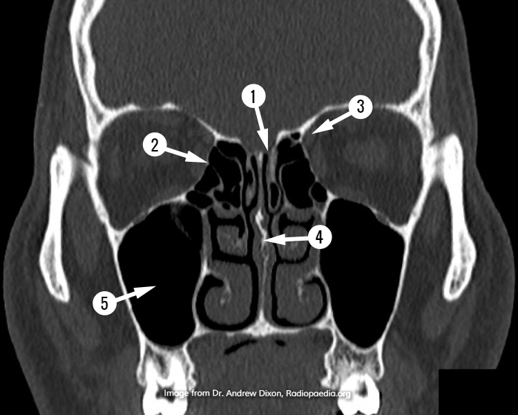 File:CT sinuses (anatomy quiz) (Radiopaedia 60519).jpg