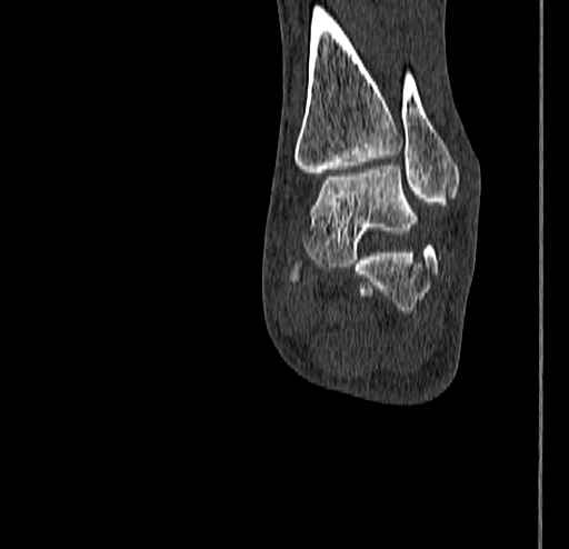 Calcaneal fracture - Sanders type 4 (Radiopaedia 90179-107370 Coronal bone window 63).jpg