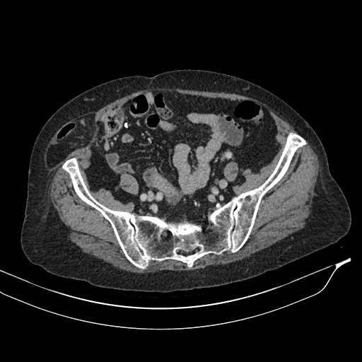 Calcified adrenal glands and Spigelian hernia (Radiopaedia 49741-54988 A 178).jpg