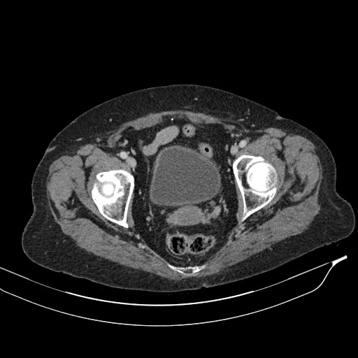 Calcified adrenal glands and Spigelian hernia (Radiopaedia 49741-54988 A 220).jpg