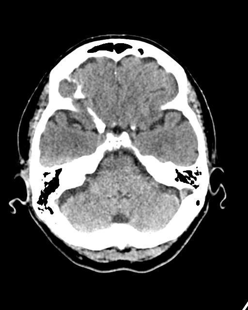 Calcified meningioma (Radiopaedia 74361-85243 Axial non-contrast 38).jpg