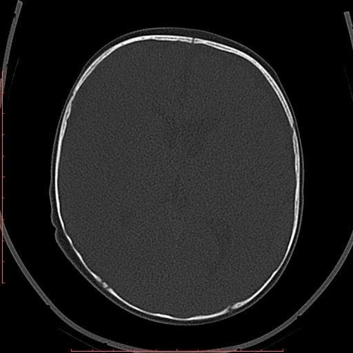 Calcified middle cerebral artery embolism (Radiopaedia 78949-91860 Axial bone window 34).jpg