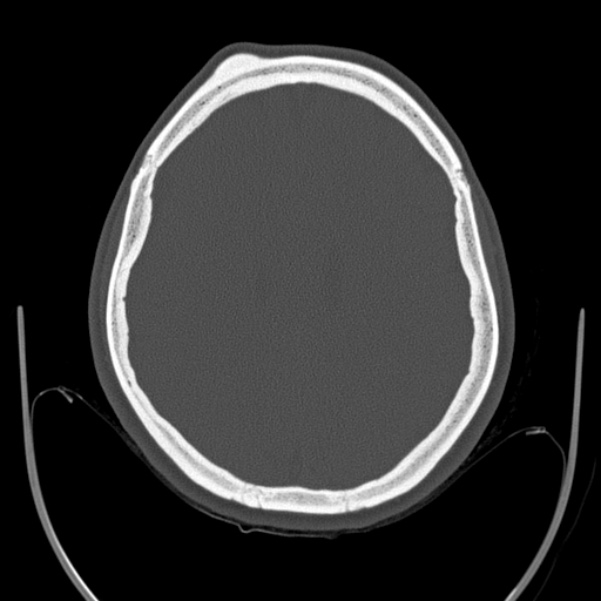 Calvarial osteoma (Radiopaedia 36520-38079 Axial bone window 72).jpg