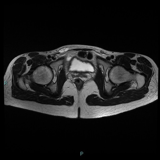 File:Canal of Nuck cyst (Radiopaedia 55074-61448 Axial T2 16).jpg
