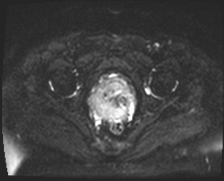 Cancer cervix - stage IIb (Radiopaedia 75411-86615 Axial DWI 9).jpg