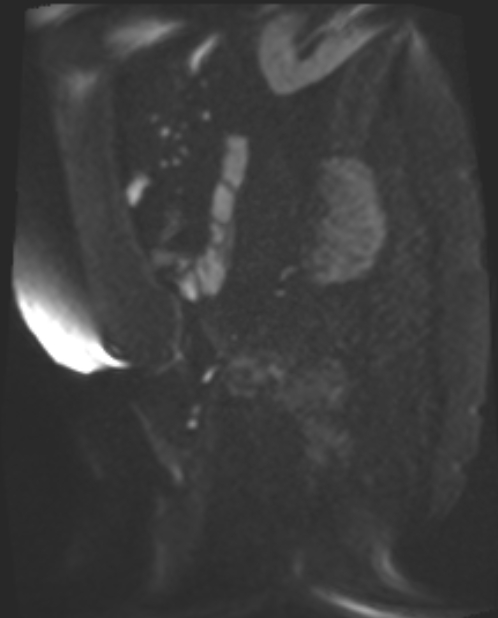 Cancer cervix - stage IIb (Radiopaedia 75411-86615 Sagittal DWI 49).jpg