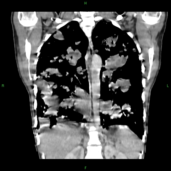 File:Cannon ball metastases - synovial sarcoma (Radiopaedia 26135-26271 Coronal liver window 12).jpg