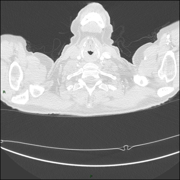 Cannonball metastases (Radiopaedia 82110-96150 Axial lung window 10).jpg