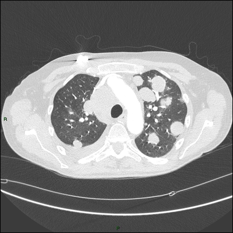 Cannonball metastases (Radiopaedia 82110-96150 Axial lung window 65).jpg