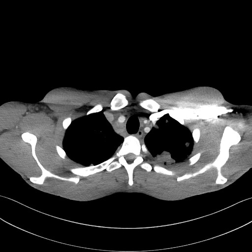 Cannonball metastases - testicular choriocarcinoma (Radiopaedia 84510-99891 B 27).jpg
