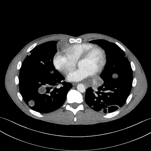 Cannonball metastases - testicular choriocarcinoma (Radiopaedia 84510-99891 B 73).jpg