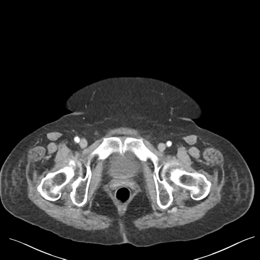 Cannonball metastases from endometrial cancer (Radiopaedia 42003-45031 E 75).png