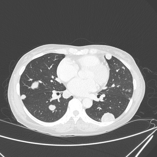 File:Canonball lung metastasis (Radiopaedia 77634-89837 Axial lung window 103).jpg