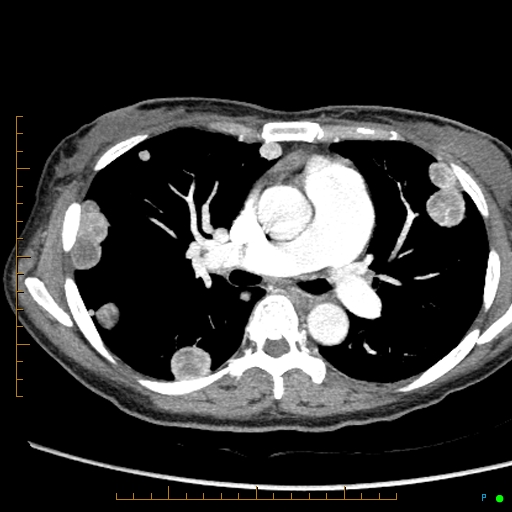 Canonball lung metastasis (Radiopaedia 77634-89837 B 42).jpg