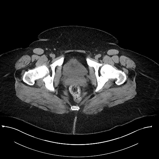 Carcinoid tumor - terminal ileum (Radiopaedia 60931-68740 Axial non-contrast 123).jpg