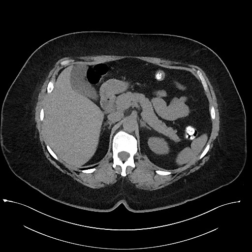 Carcinoid tumor - terminal ileum (Radiopaedia 60931-68740 Axial non-contrast 28).jpg