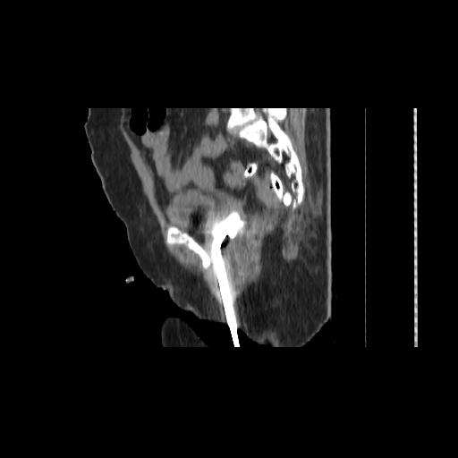 File:Carcinoma cervix- brachytherapy applicator (Radiopaedia 33135-34173 D 109).jpg