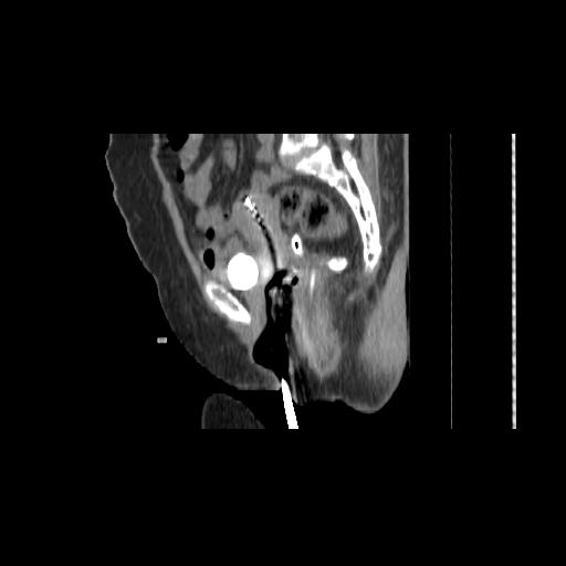 File:Carcinoma cervix- brachytherapy applicator (Radiopaedia 33135-34173 D 82).jpg