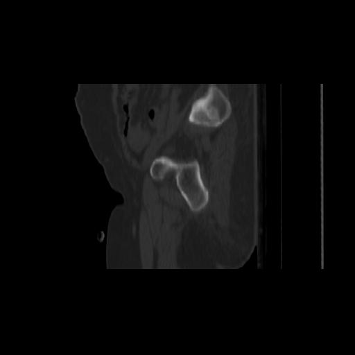 Carcinoma cervix- brachytherapy applicator (Radiopaedia 33135-34173 Sagittal bone window 30).jpg