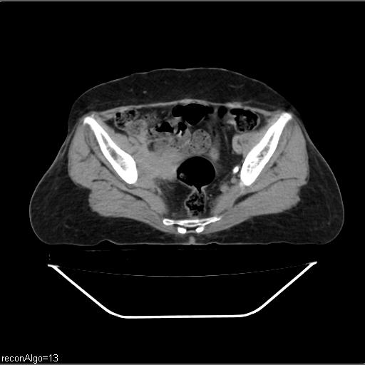 File:Carcinoma cervix- recurrence (Radiopaedia 34702-36137 Axial C+ delayed 20).jpg