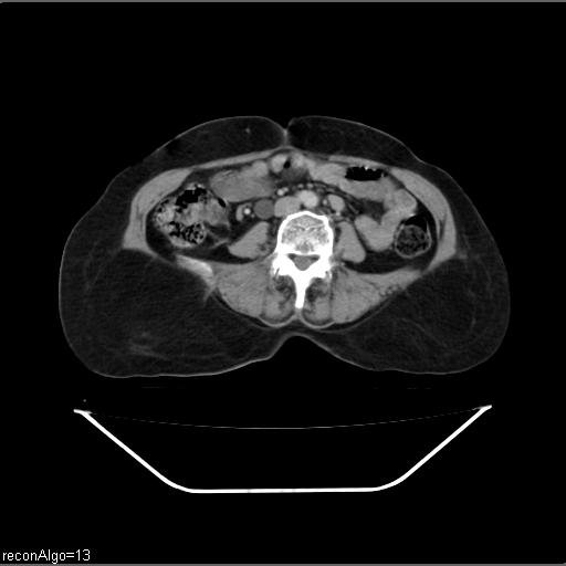 Carcinoma cervix- recurrence (Radiopaedia 34702-36137 B 32).jpg