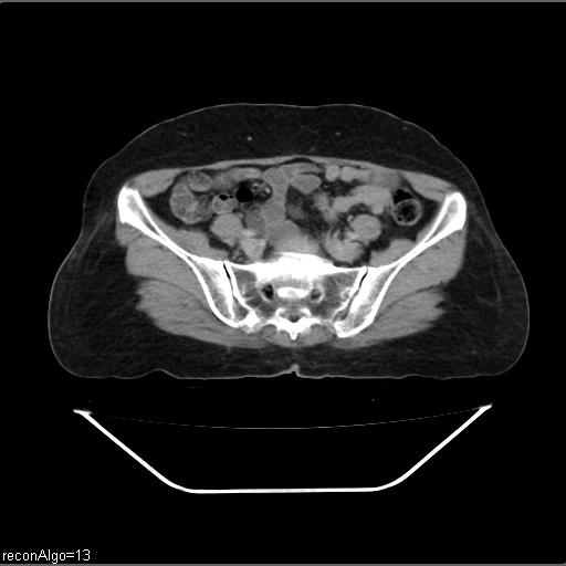 File:Carcinoma cervix- recurrence (Radiopaedia 34702-36137 B 39).jpg