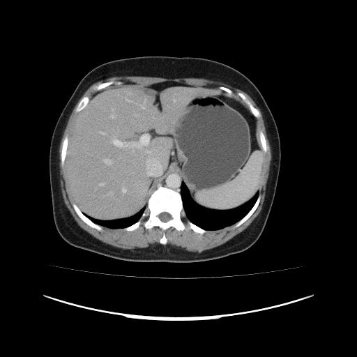 File:Carcinoma colon - hepatic flexure (Radiopaedia 19461-19493 A 30).jpg