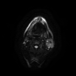 Carcinoma ex-pleomorphic adenoma of parotid (Radiopaedia 28383-28627 Ax DWI B-500 GE 49).jpg