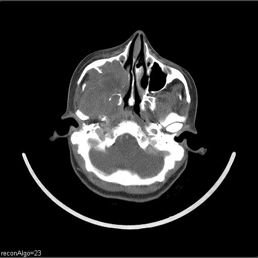 Carcinoma of the maxillary antrum (Radiopaedia 53805-59888 Axial C+ delayed 56).jpg