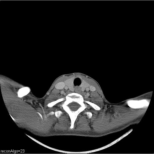 File:Carcinoma of the maxillary antrum (Radiopaedia 53805-59888 Axial C+ delayed 6).jpg