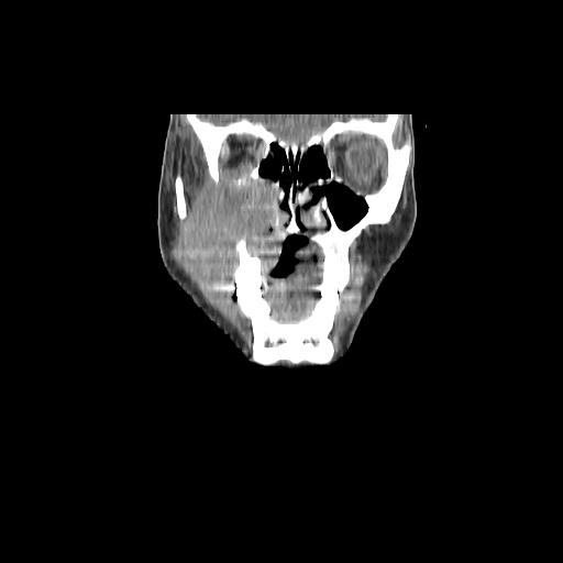 Carcinoma of the maxillary antrum (Radiopaedia 53805-59888 Coronal C+ delayed 34).jpg