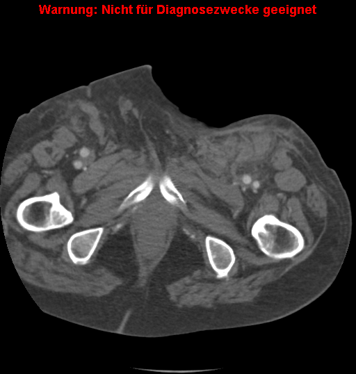 File:Cardiac perforation following transcatheter aortic valve implantation (Radiopaedia 23714-23863 B 16).png