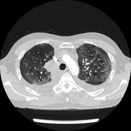 Cardiac tamponade (Radiopaedia 78607-91368 Axial lung window 18).jpg