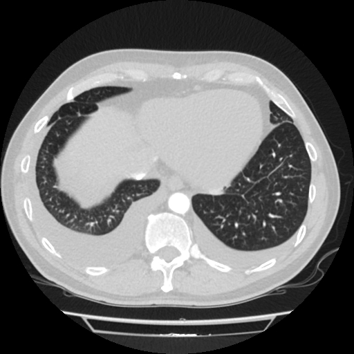 File:Cardiac tamponade (Radiopaedia 78607-91368 Axial lung window 75).jpg