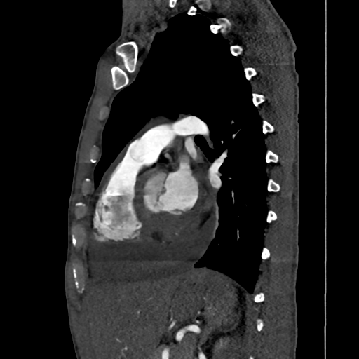 Cardiac tumor - undifferentiated pleomorphic sarcoma (Radiopaedia 45844-50134 B 29).png