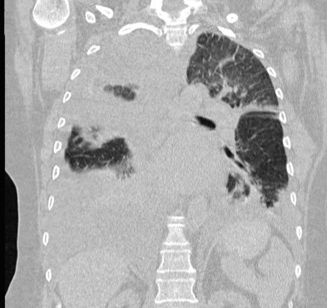 Cardiogenic pulmonary edema (Radiopaedia 29213-29609 Coronal lung window 43).jpg