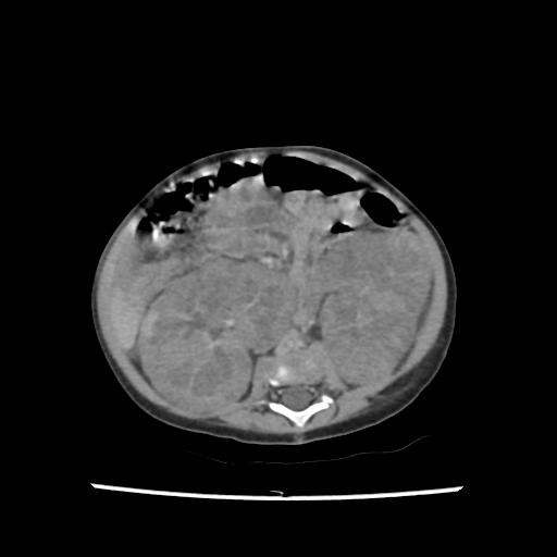 Caroli disease with autosomal recessive polycystic kidney disease (ARPKD) (Radiopaedia 89651-106703 B 130).jpg