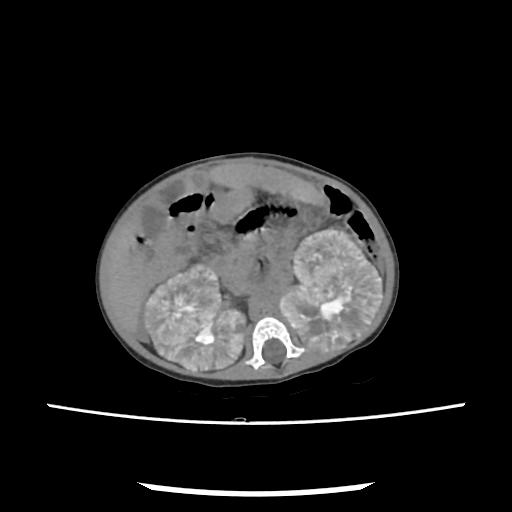 Caroli disease with autosomal recessive polycystic kidney disease (ARPKD) (Radiopaedia 89651-106703 E 111).jpg