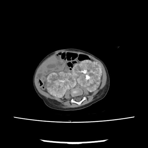Caroli disease with autosomal recessive polycystic kidney disease (ARPKD) (Radiopaedia 89651-106703 E 158).jpg