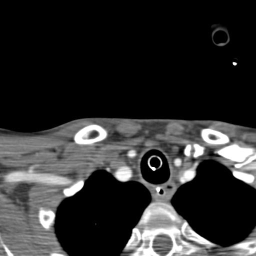 Carotid arterial dissection (Radiopaedia 30001-30548 B 24).jpg