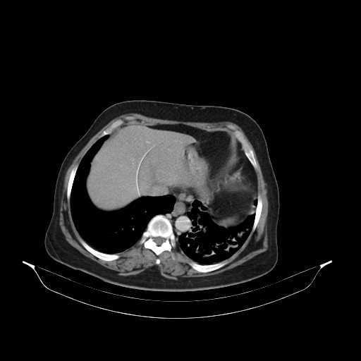 File:Carotid body tumor (Radiopaedia 21021-20948 B 54).jpg