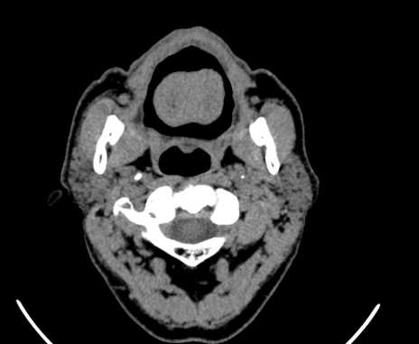 Carotid body tumor (Radiopaedia 61750-69757 Axial non-contrast 17).jpg